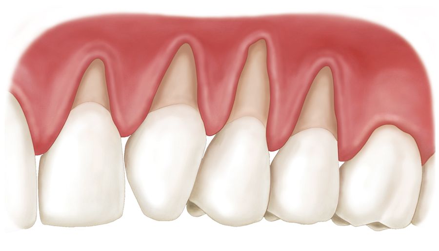 Top Gum Repair Toothpaste for Loose Teeth and Gum Recession