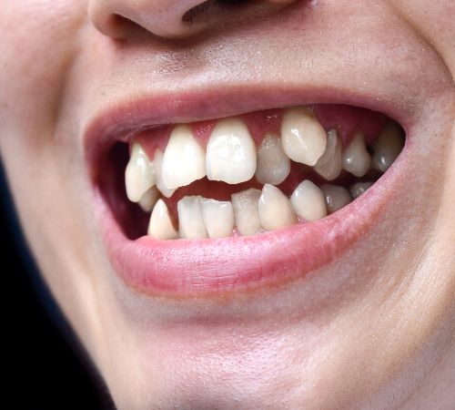 My Teeth Feel Loose – Is It Gum Disease?