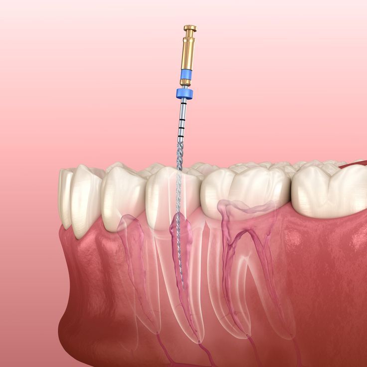 How to Prevent Further Damage After Root Canal Treatment