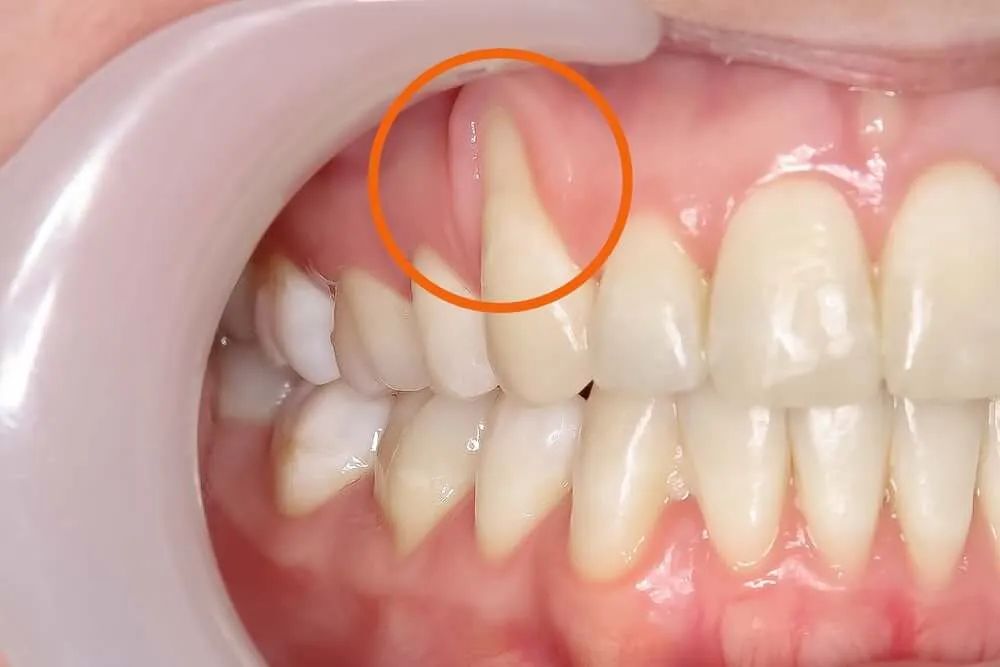 How to Fix Receding Gums Without Surgery