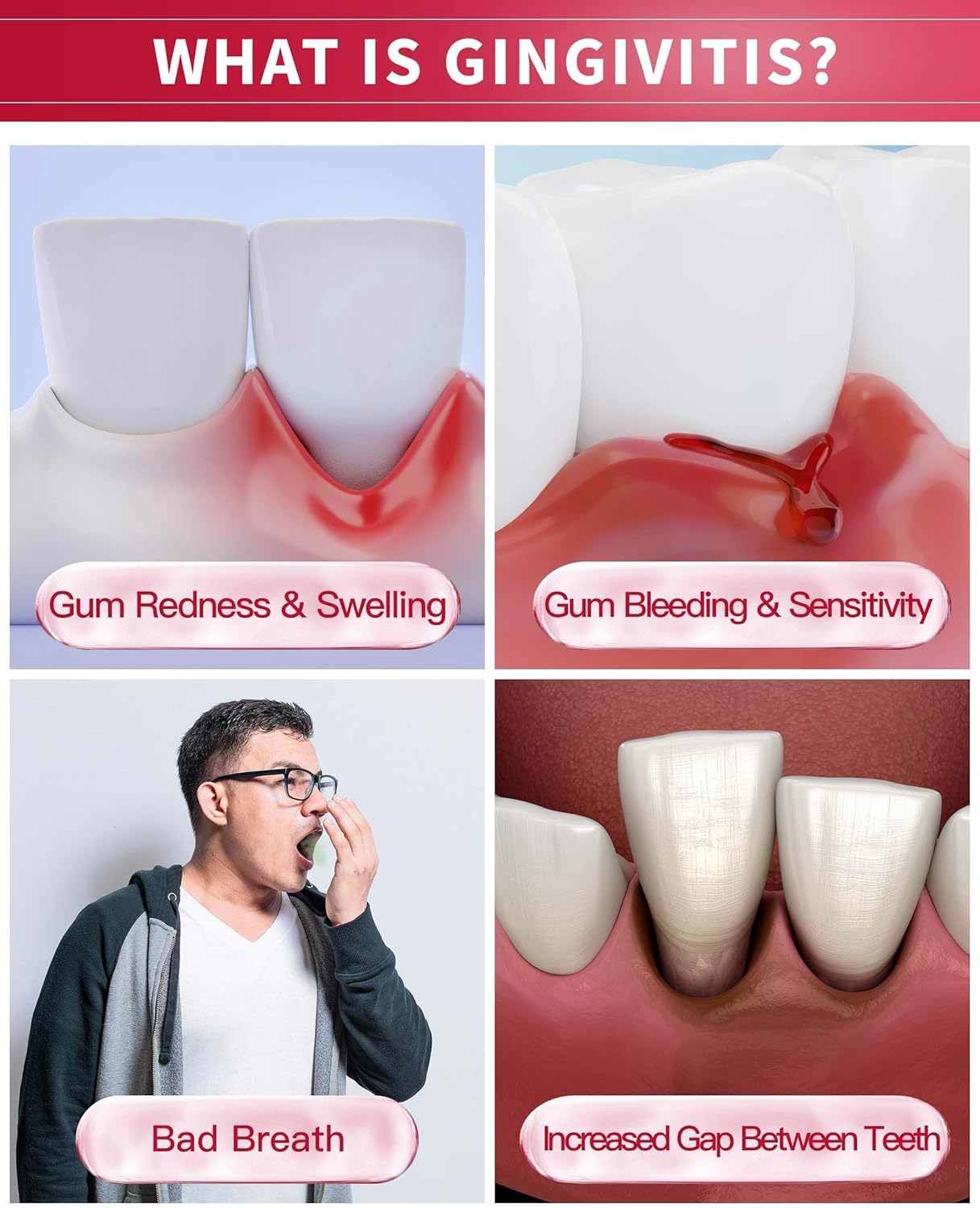 CAREDO Gingivitis Toothpaste Gum Repair for Bleeding Gums, Swollen Gums Treatment for Gum Sensitivity, Gingivitis Treatment for Gum Disease, Reverse Gingivitis Treatment for Adults Oral Care, 3.52OZ